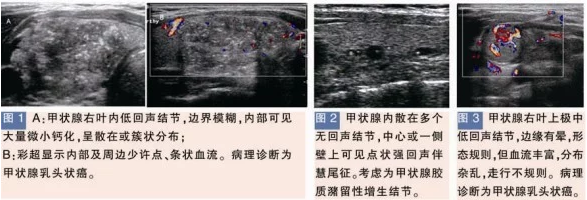 甲狀腺良性結節的特征性表現彩超檢測圖